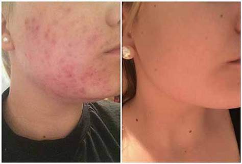 annaschmidt-berlin.com_akne